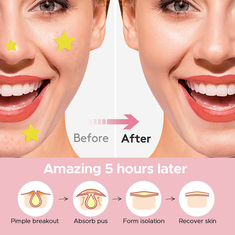 600 PCS/Set Star Pimple Patch  – Beauty Makeup Tools recenzja i cena